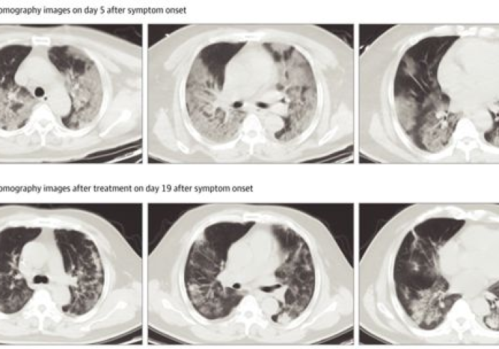 【新型冠状的症状是什么?/新型冠状的新症状】 【新型冠状的症状是什么?/新型冠状的新症状】
