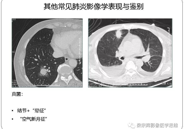 【廊坊首例新型冠状肺炎/廊坊第一例肺炎】 【廊坊首例新型冠状肺炎/廊坊第一例肺炎】
